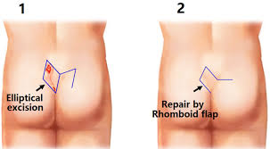 Both are associated with abscesses in the region, and both involve an unnatural channel through the tissue. Pilonidal Sinus Definition Causes Symptoms Diagnosis Treatment