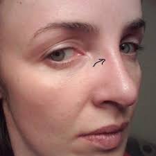 Are you still upset that your glasses have slipped and left a deep dent in your nose？ try our product! Persistent Indentations On Nose Bridge After Having Sunglasses On For Just 5 Seconds 2 Weeks After Rhinoplasty Photos