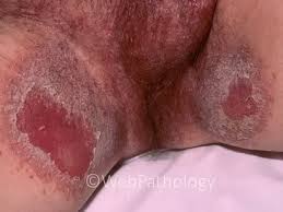 Image result for Candidiasis