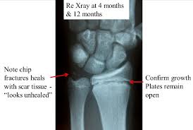 Image result for Hand Growth Plates