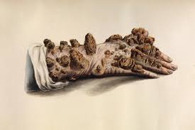 Image result for Leprosy