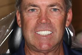 Check out these amazing before/after photos for our awesome patient! 🤩  Shawn incurred significant dental trauma from a softball accident in the  past. The accident caused tooth loss as well as gradual