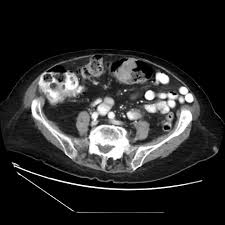 Check spelling or type a new query. Colocolonic Intussusception Radiology Case Radiopaedia Org