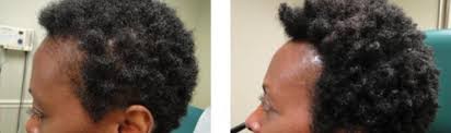 Fda cleared to treat hair loss and stimulate hair growth. Prp For Hair Loss Philadelphia Non Surgical Balding Treatment