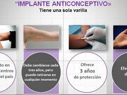 Los anticonceptivos reversibles de larga duración, arld son los anticonceptivos más eficaces para evitar un embarazo. Hospitales De Lima Ofrecen Implante Anticonceptivo Gratis Lima El Comercio Peru