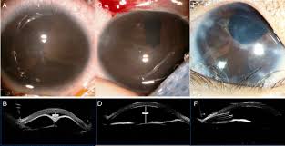 Outcome of Ahmed glaucoma valve implant in congenital fibrovascular  pupillary membrane with secondary glaucoma