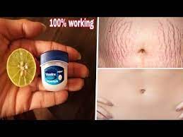 How To Remove Stretch Mark On Pregnancy Belly Breast With Vesline And Lemon Apply Natural Remedy Youtube