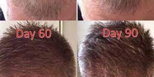 Platelet Rich Plasma Prp Prp For Hair Restoration Prp Before And After Prp Hair Loss Results Platelet Rich Plasma Prp For Hair Loss Hair Restoration