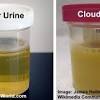 Holding your urine for a long time could cause condition. 1