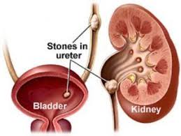 Urinary Tract And Kidney Disease Symptoms And Signs Medical Terminology Remedies For Kidney Infection Kidney Stones Symptoms Treat Kidney Stones