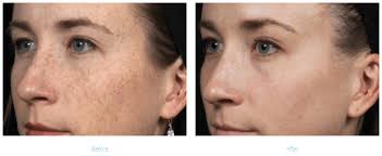 Pigmentation refers to the coloring of the skin. What Is The Best Treatment For Hyperpigmentation Sun Damage Laser Skin Care Center