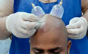 There is no research or study showing that hijama affects the slowing of hair loss. Head Hijama For Hair