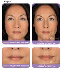 Juvéderm fillers plump lips, volumize cheeks, and smooth lines. Juvederm Facial Filler Maryland Bethesda Rockville Silver Spring