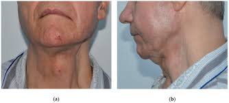 Autologous Fat Grafting for Craniofacial Reconstruction in Oncologic  Patients