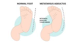 Image result for In-Toeing