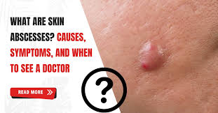 Image result for Skin Abscess