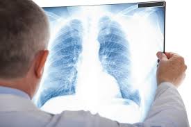 .om alvo de pvc = 4mmhg, desde que o paciente esteja com pam maior que 60 mmhg, sem o uso de vasopressores. Sepse Pulmonar O Que E Sintomas E Tratamento Tua Saude