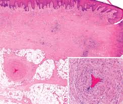 Maybe you would like to learn more about one of these? Https Www Zora Uzh Ch 41796 4 Martorell Hypertensive Ischemic Leg Ulcer Cs Pdf