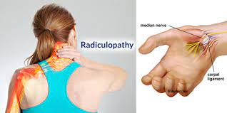 The Double Crush When A Nerve Pinches In 2 Places Mayfield Brain Spinal Column