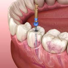 Check spelling or type a new query. Root Canals In Phoenix Myths Dr John Ludu