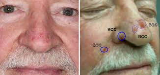 Basal cell carcinoma is the most frequent skin cancer, and it often shows up on the nose. Multiple Nasal Basal Cell Carcinomas Skin Cancer And Reconstructive Surgery Center