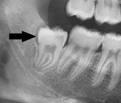 Zahnärzte und oralchirurgen entfernen die weisheitszähne, wenn sie platzmangel im kiefer, entzündungen und weisheitszahnentfernung: Weisheitszahnentfernung Dr Michael Korsch