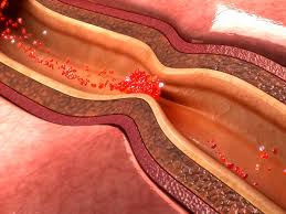 How to help you recover from cad naturally. Heart Disease The Arab Hospital Magazine