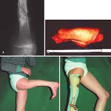 Osteosarcoma of the femur with skip, lymph node, and lung metastases. A 10 Year Old Boy With Osteosarcoma In The Right Distal Femur Download Scientific Diagram