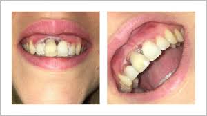 Bleach is the generic name for any chemical product that is used industrially and domestically to remove color from a fabric or fiber or to clean or to remove stains in a process called bleaching. Billigangebot Zahnfleisch Verbrannt Beim Bleaching Dental Team Online