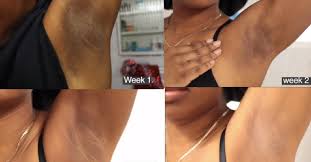 Dark spots on the arms and legs are quite common and there are multiple reasons behind them. Natural Ways To Lighten And Prevent Dark Underarms