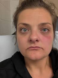 Timing of Antiviral Treatment for Shingles