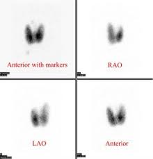 A I 123 Thyroid Uptake Scan Nuclear Medicine Pet Ct Nuc Med