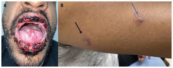 Image result for Erythema Multiforme Major