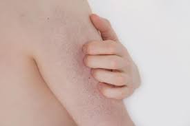 Chemical peeling juga bisa menjadi salah satu cara menghilangkan bopeng di wajah. Keratosis Pilaris Gejala Penyebab Obat Dll Hello Sehat