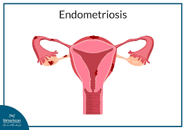 Image result for Female Infertility