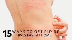 15 Ways To Get Rid Of Hives Fast At Home Get Rid Of Hives Home Remedies For Hives Allergy Hives
