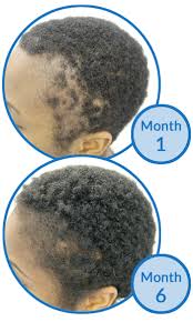 Hair loss after bariatric surgery. Ccca Hair Loss In Black Women Unfairly Trivialised Says Uk Doctor