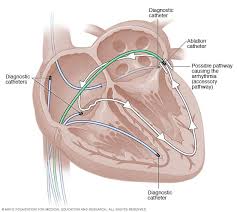 Cardiac Catheter Ablation Cardiac Catheterization Heart Catheterization Cardiac