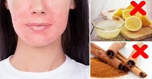 Satu lagi petua hilangkan jerawat ialah dengan menggunakan minyak zaiton, lemon dan juga bedak sejuk. 7 Bahan Selamat Tapi Sebenarnya Bahaya Selalu Kita Guna Dalam Petua Cantik Awas Ya Vanilla Kismis