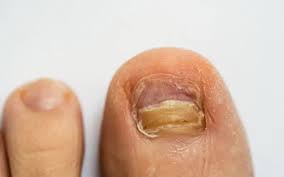 Image result for Pitting nails feet