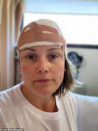 According to the american cancer society, just over 100,000 new cases of skin cancer are diagnosed in the united states each year. Katie Maxwell Reveals How A Tiny Lump On Her Head Turned Out To Be Skin Cancer Daily Mail Online