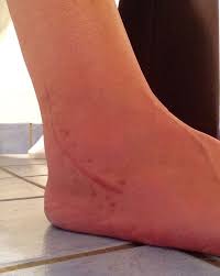 You will be given medicines to take home to control the pain. Pin On Surgery