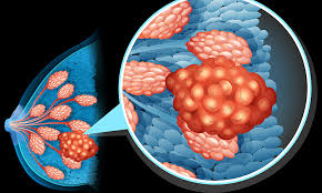 Breast cancer isn't what it was 20 years ago. Sanguinarine Shows Promise Against Triple Negative Breast Cancer