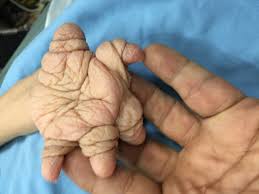 Pathogenesis is associated with a lack of catalysts involved in iron. Plummer Vinson Syndrome The Gastrointestinalatlas Gastrointestinalatlas Com