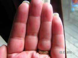 I turned burned and 300% times darker. Word Of Advice Chemical Burns Quiltingboard Forums