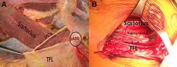 Proximal Rectus Femoris Avulsion Repair Sciencedirect