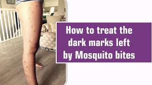 Reapply topical medication every 4 hours. How To Treat The Dark Marks Left By Mosquito Bites Youtube