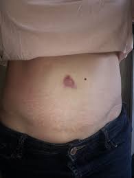 Need Belly Button Fixed Ask A Surgeon