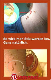 So Wird Man Stielwarzen Los Ganz Naturlich Gesundheit Health Fitness Motivation Beauty Hacks Stielwarzen Gesundheit Schonheitstricks