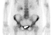 Da man ein szintigramm mithilfe von schwach radioaktiven substanzen erstellt, ist die szintigraphie eine nuklearmedizinische untersuchung. Szintigraphie Der Knochen In Der Nuklearmedizinischen Praxis Atos Klinik Heidelberg